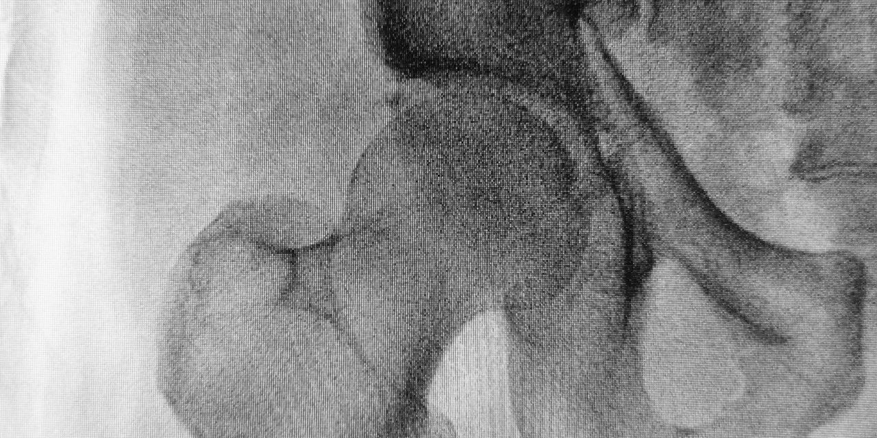 Jak leczy się uszkodzone panewki?