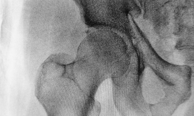 Jak leczy się uszkodzone panewki?